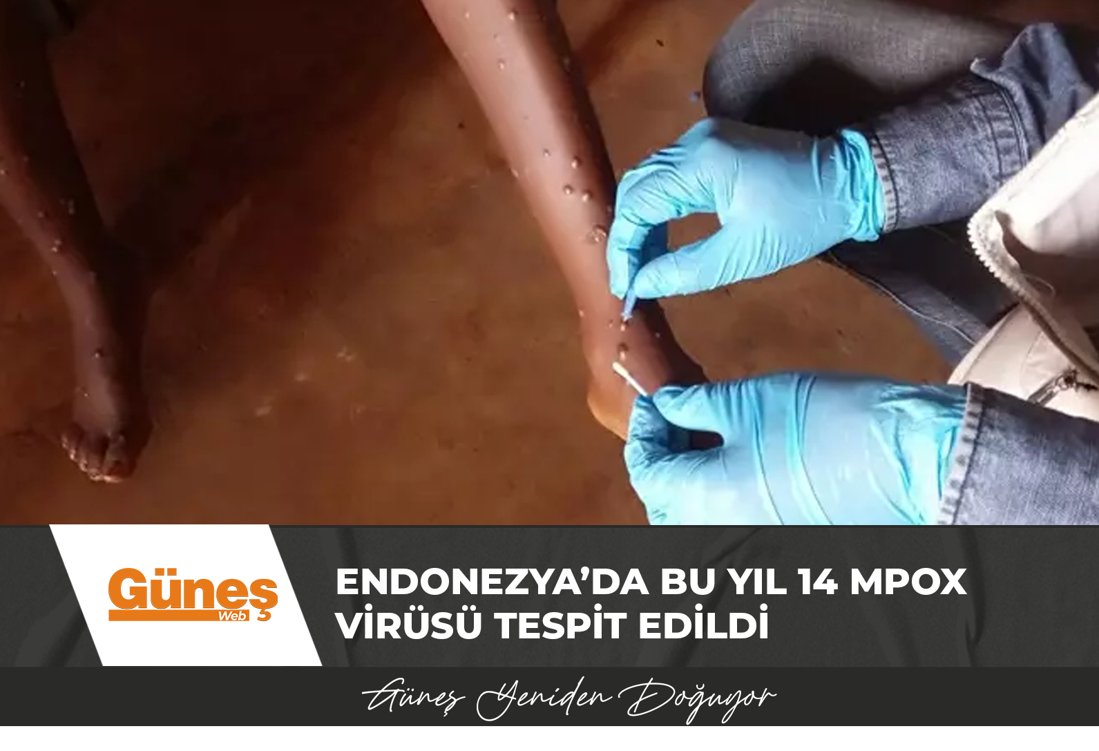 Endonezya’da Bu Yıl 14 Mpox Virüsü Tespit Edildi